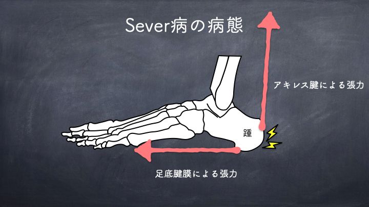 Sever病の病態